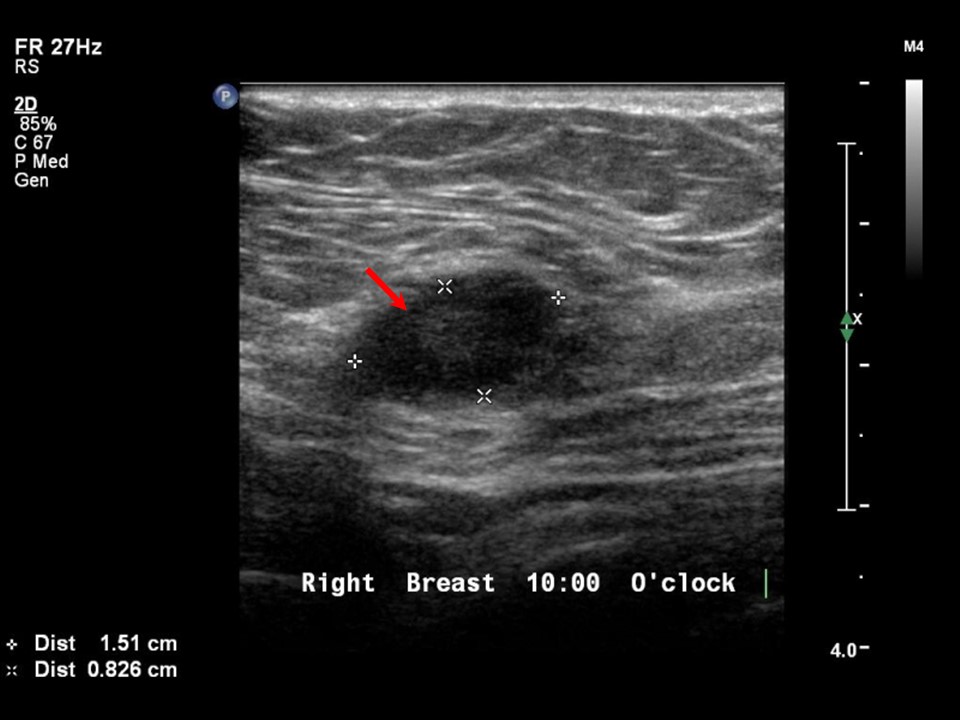 Atlas of breast cancer early detection