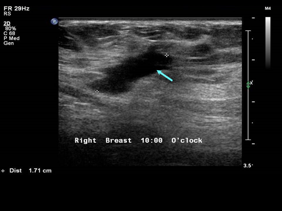 Atlas of breast cancer early detection