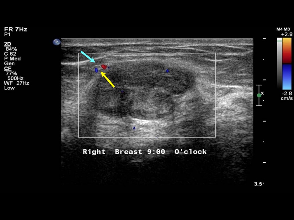 Atlas of breast cancer early detection