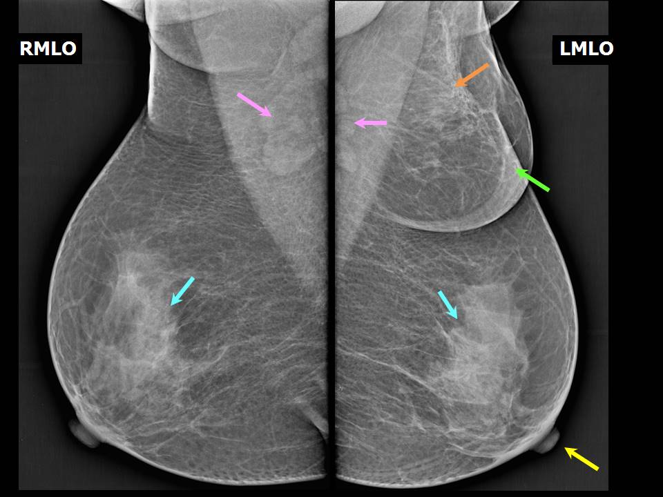 Atlas of breast cancer early detection