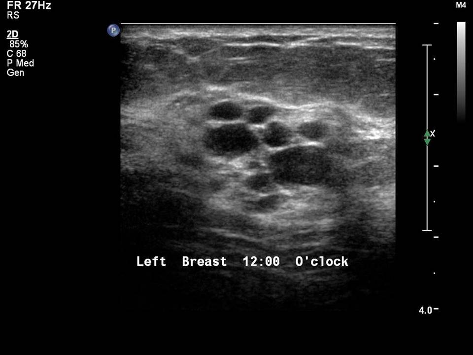 Atlas of breast cancer early detection