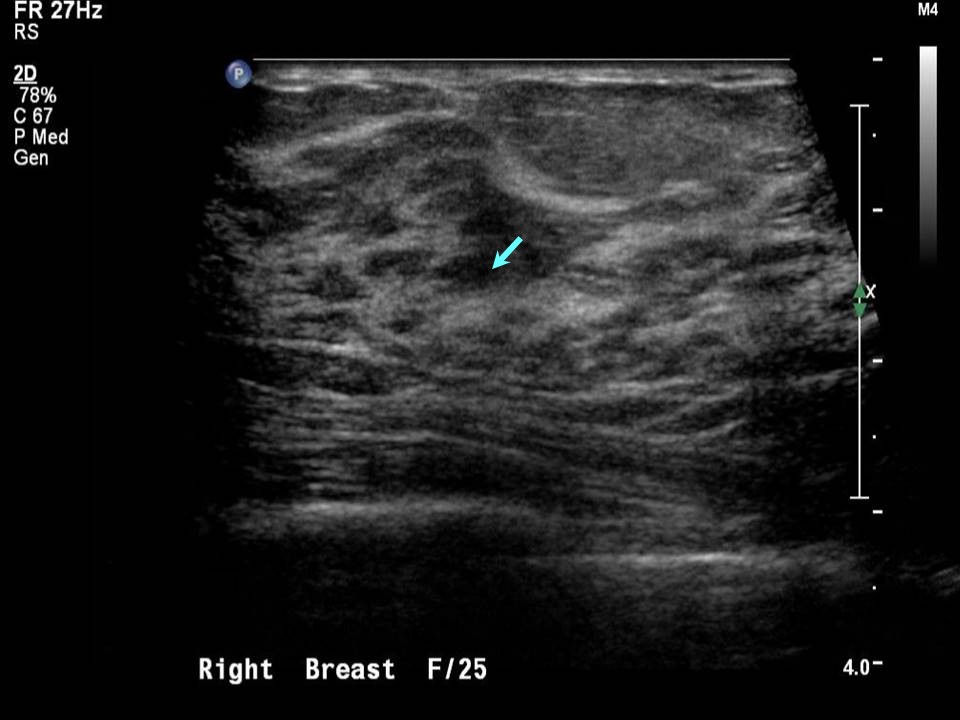 Atlas of breast cancer early detection