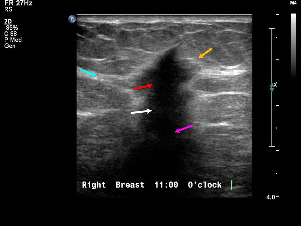Atlas of breast cancer early detection