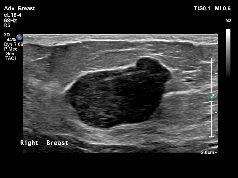 Atlas of breast cancer early detection