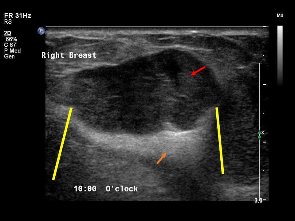 Atlas of breast cancer early detection