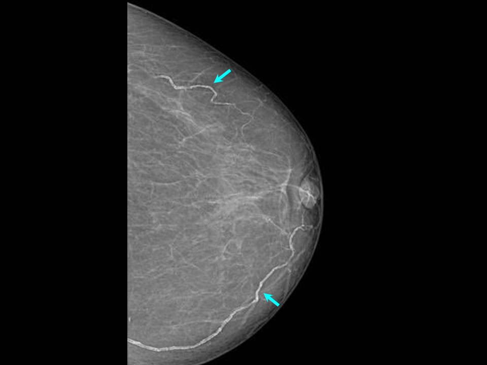 Atlas of breast cancer early detection