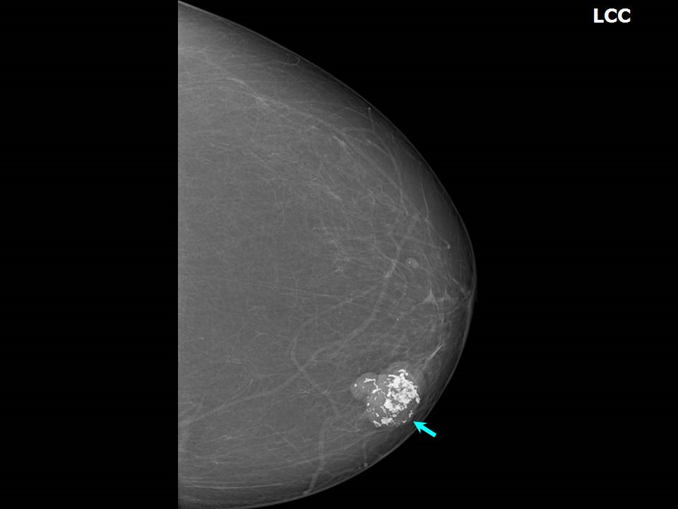 Atlas of breast cancer early detection