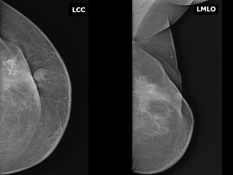 Atlas of breast cancer early detection