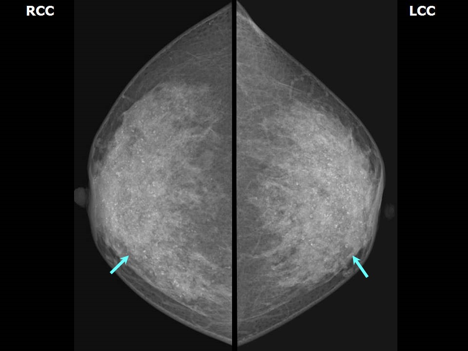 Atlas of breast cancer early detection