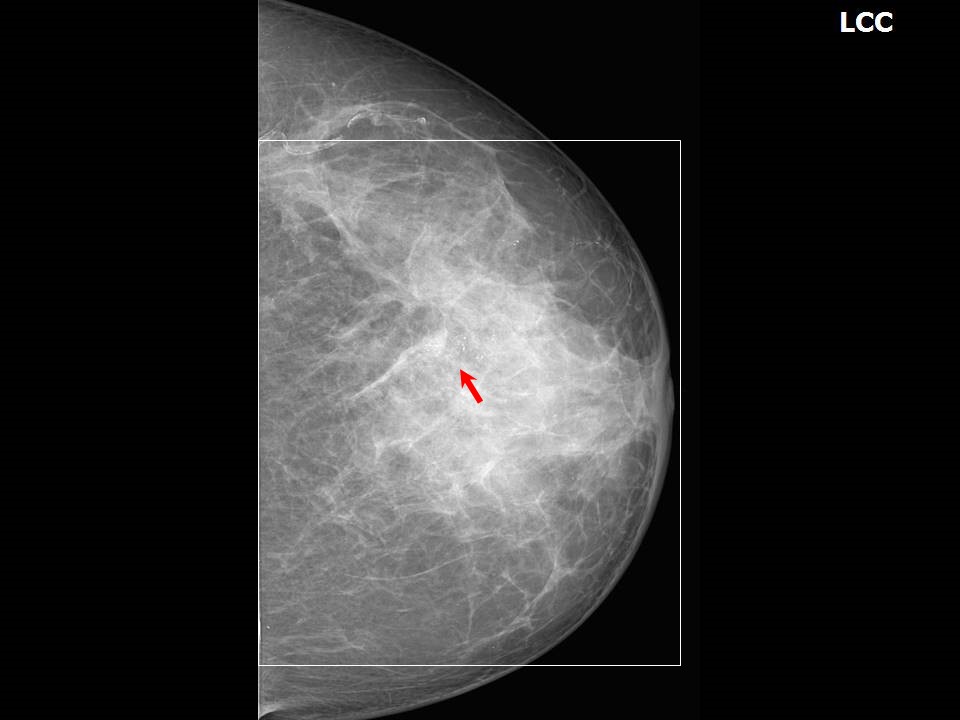 Atlas of breast cancer early detection