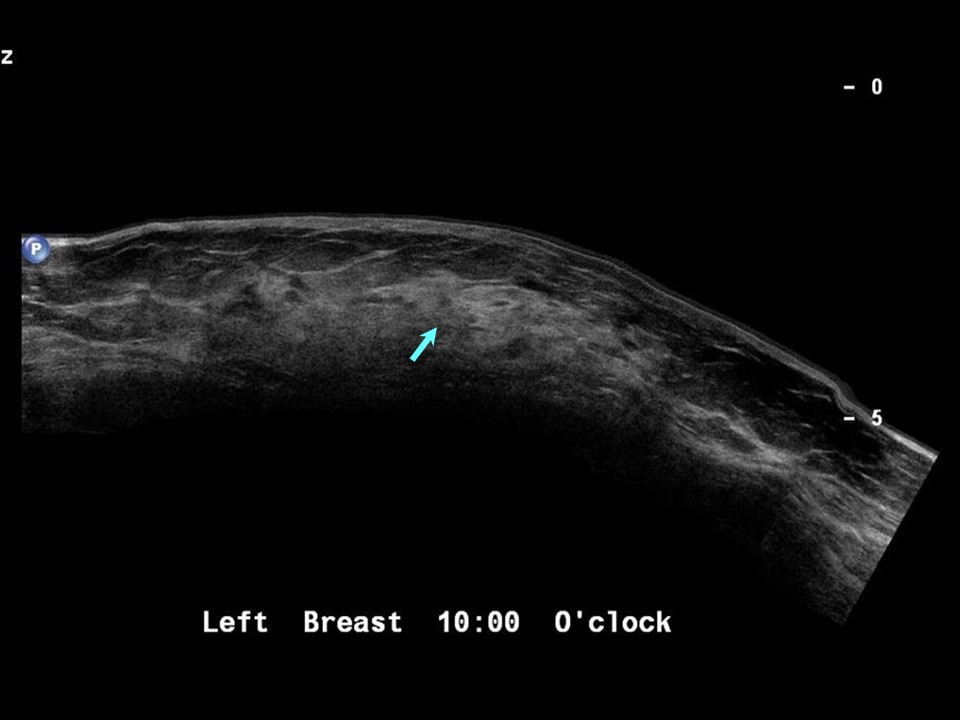 Atlas of breast cancer early detection