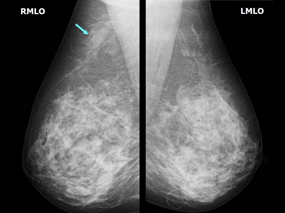 Atlas of breast cancer early detection