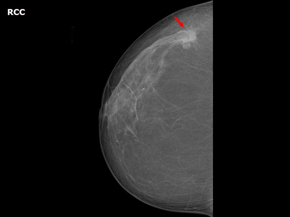 Atlas of breast cancer early detection