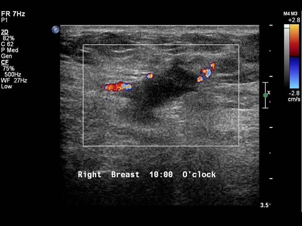 Atlas of breast cancer early detection