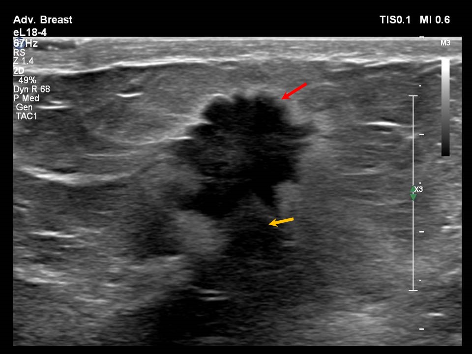 Atlas of breast cancer early detection