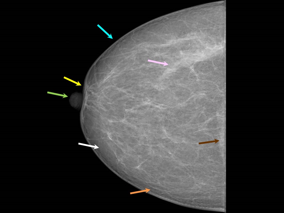Atlas of breast cancer early detection