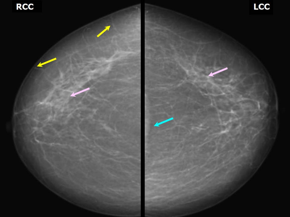 Atlas of breast cancer early detection