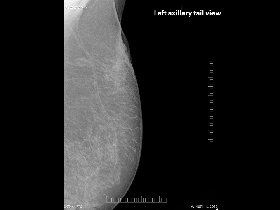 Atlas of breast cancer early detection