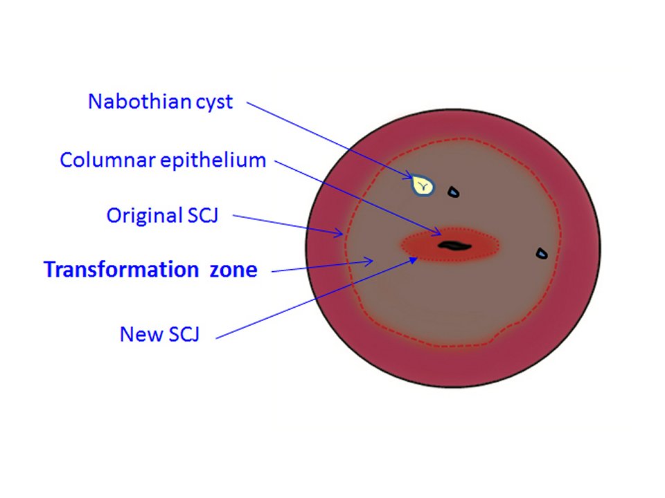 Using HPV tests for cervical cancer screening and managing HPVpositive