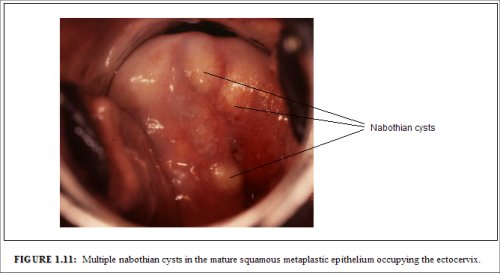 Simple Tutorial for Dummies Lump On Cervix Opening