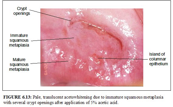 Colposcopy and treatment of cervical intraepithelial neoplasia a beginners’ manual