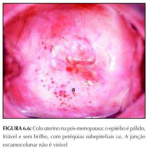 Colposcopia e tratamento da neoplasia intraepitelial cervical Manual