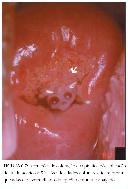 Colposcopia e tratamento da neoplasia intraepitelial cervical Manual
