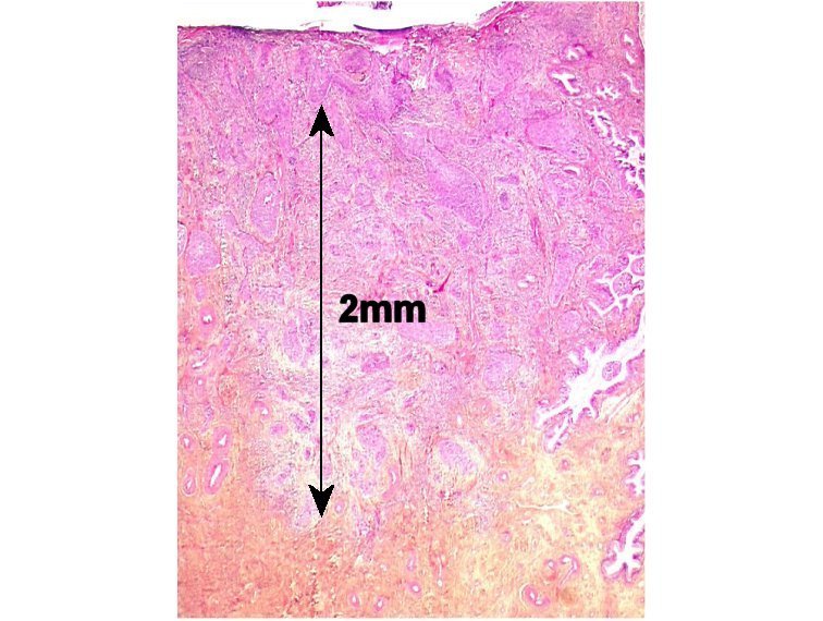 Pathology Outlines Microinvasive squamous cell carcinoma