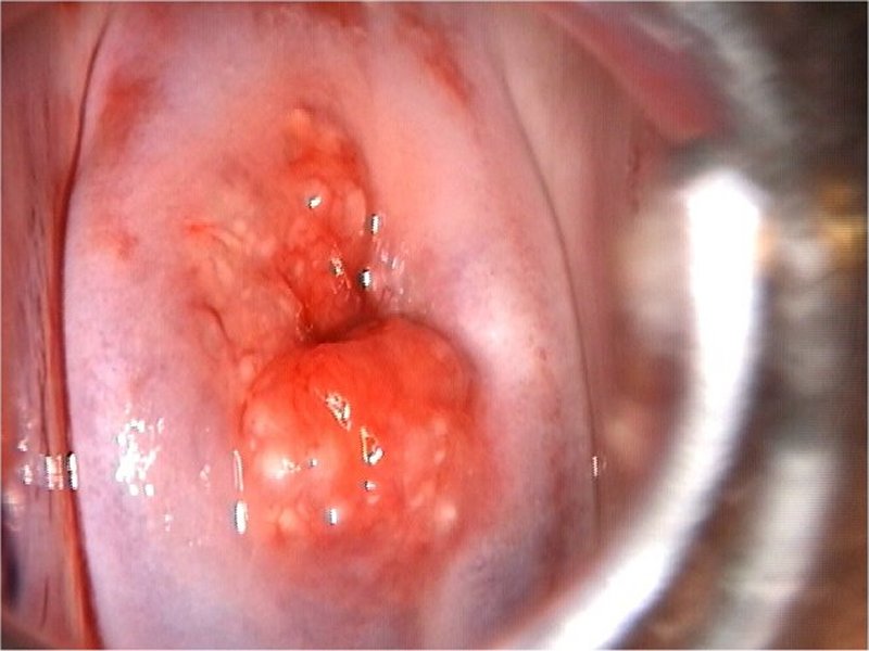 Colposcopy Digital Atlas