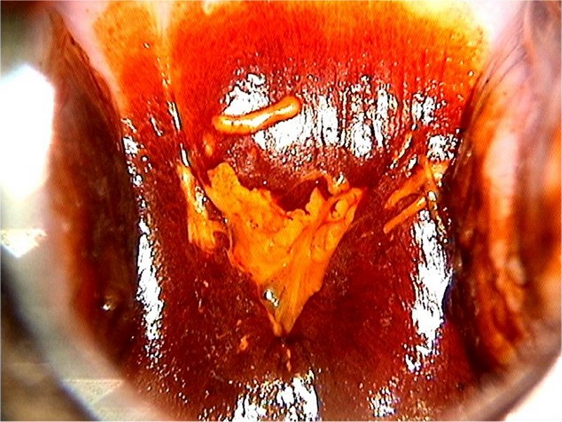 Colposcopy Digital Atlas
