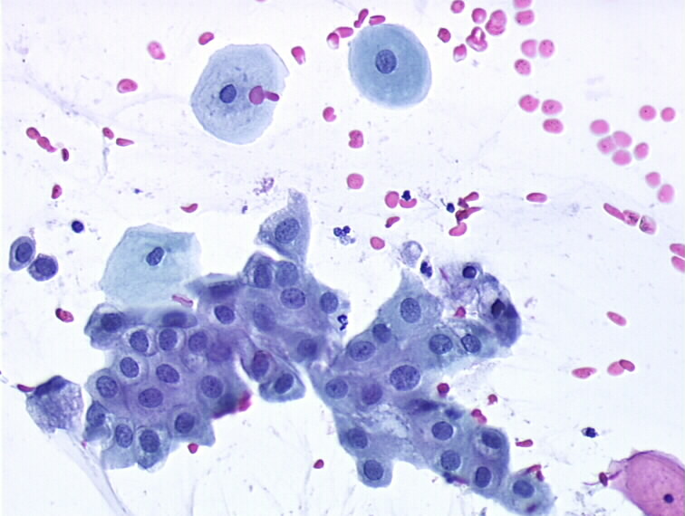 Pathology Outlines Florid ectopy
