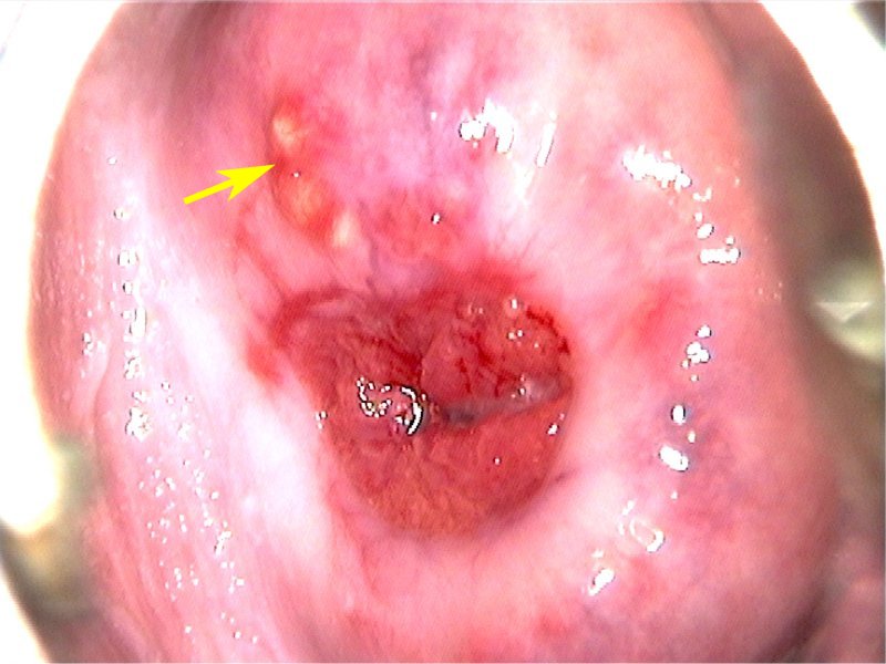Colposcopy Digital Atlas