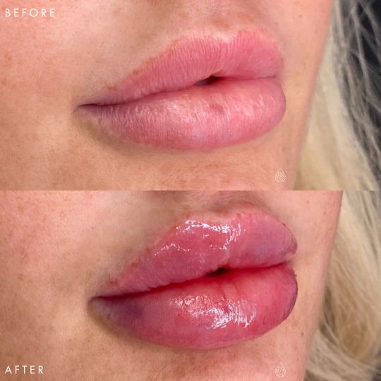 Las Vegas Lip Fillers Sculpt Spa