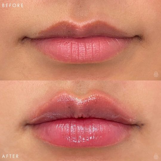 Las Vegas Lip Fillers Sculpt Spa