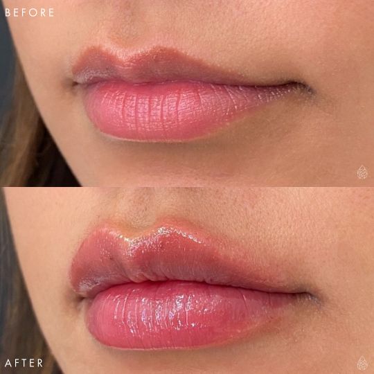 Las Vegas Lip Fillers Sculpt Spa