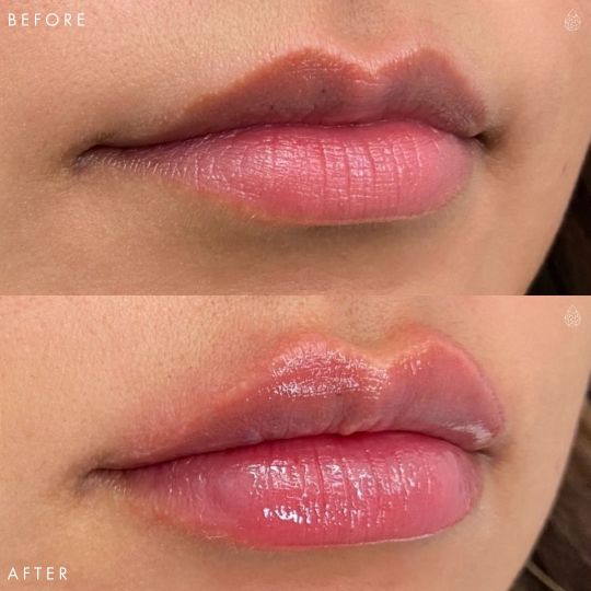 Las Vegas Lip Fillers Sculpt Spa