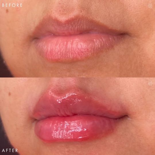 Las Vegas Lip Fillers Sculpt Spa