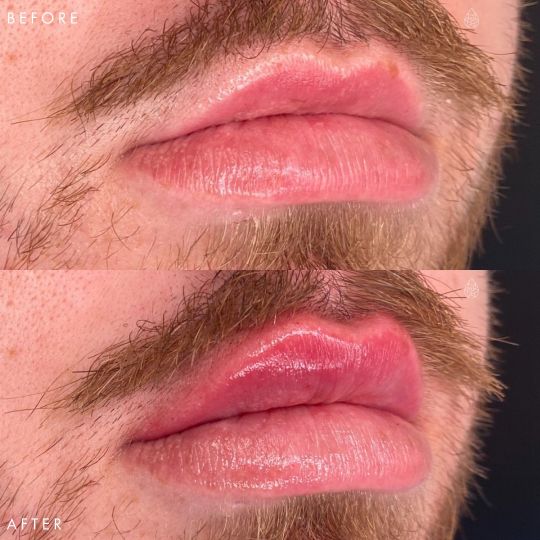Las Vegas Lip Fillers Sculpt Spa