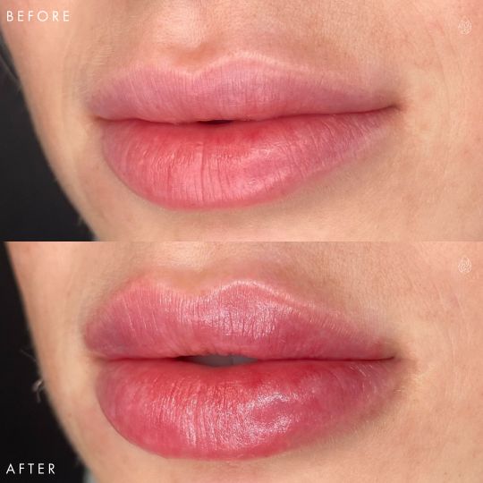 Las Vegas Lip Fillers Sculpt Spa