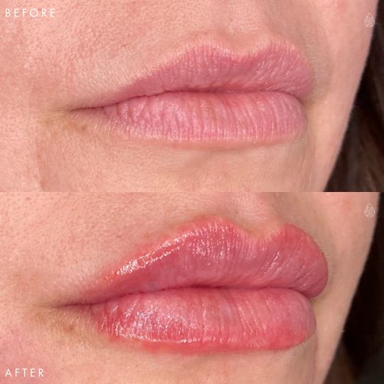 Las Vegas Aesthetic Facial Fillers Sculpt SPA