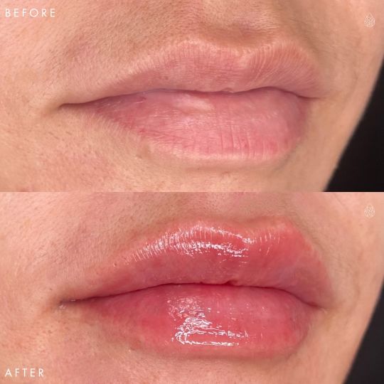 Las Vegas Lip Fillers Sculpt Spa
