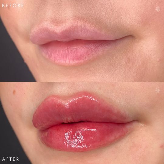 Las Vegas Lip Fillers Sculpt Spa