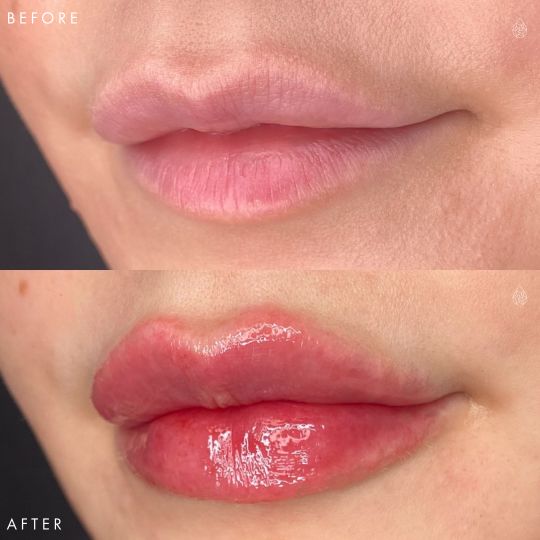Las Vegas Lip Fillers Sculpt Spa