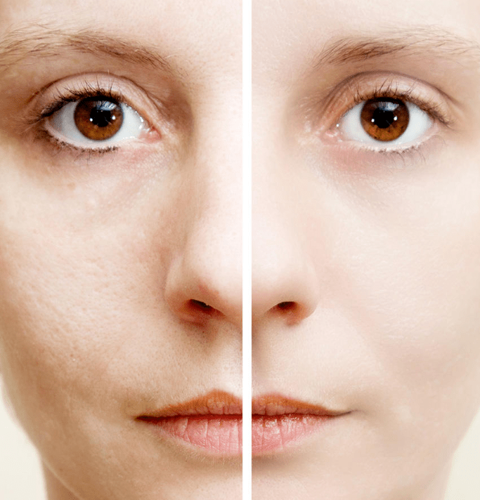 Microneedling Sculpture Body Center