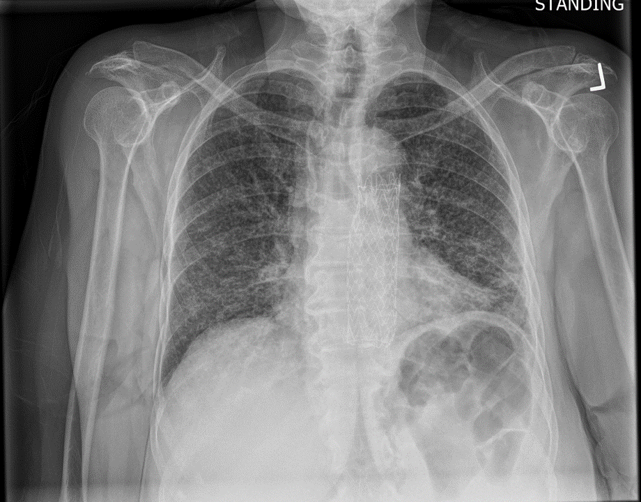 Chronic Chest Pain and This Xray… 2/11/2019 SCVMC IM Chief Resident Blog