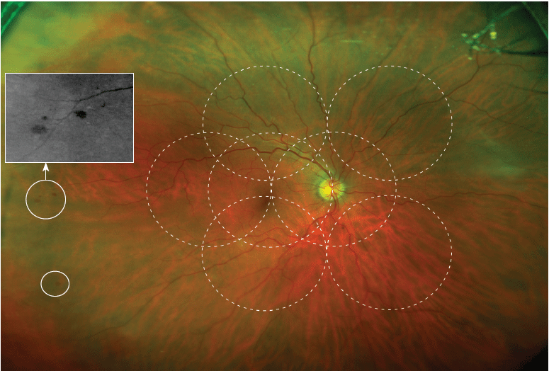 Optomap Retinal Imaging Dr. Sam Dhaliwal & Associates