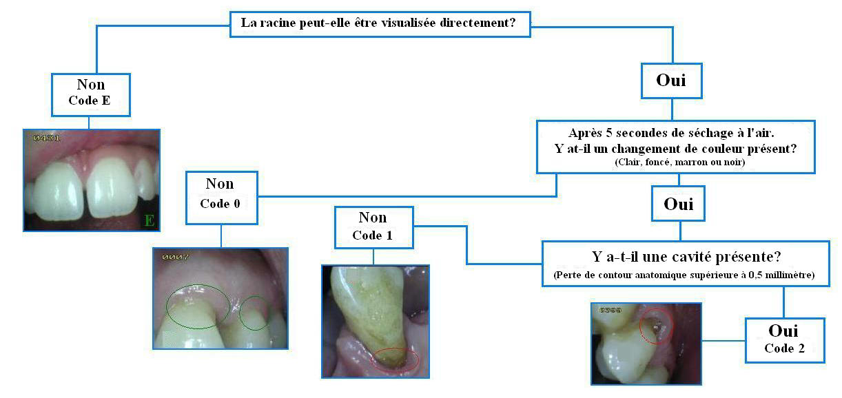 Critères de carie radiculaire