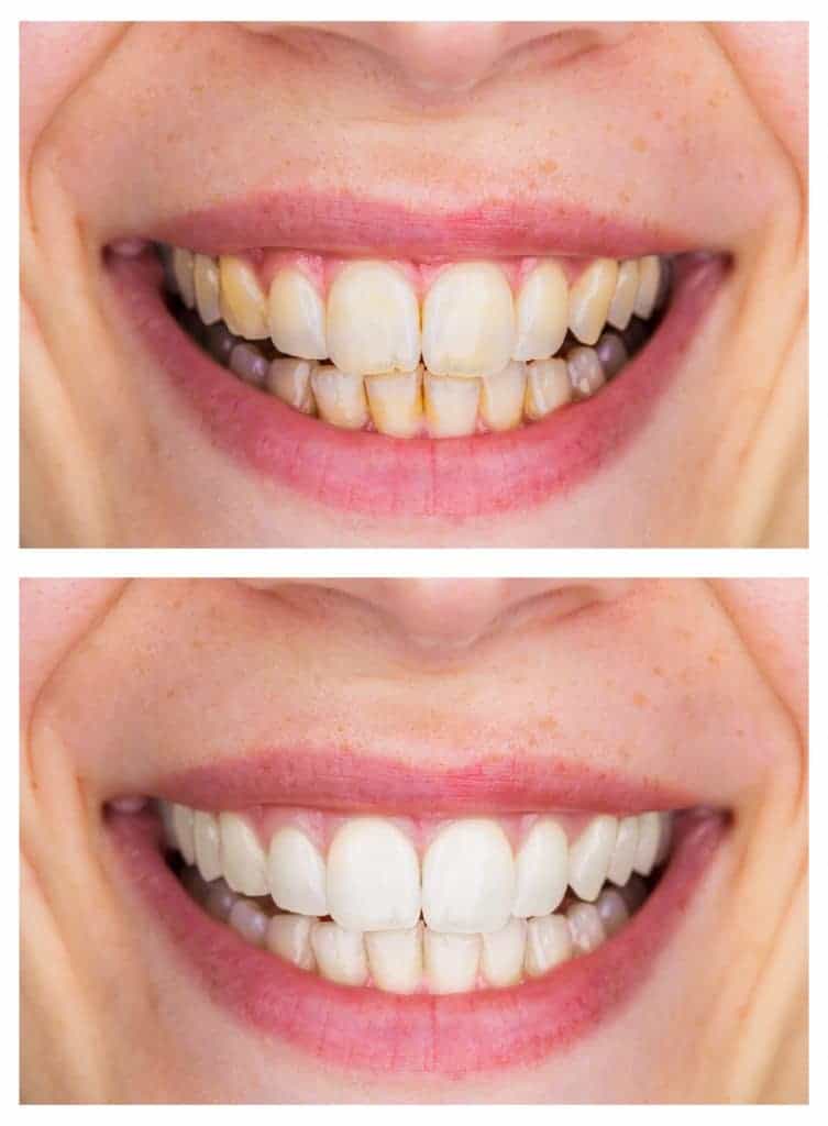 Top 5 Cosmetic Dentistry Frequently Asked Questions SeaCliff Dental