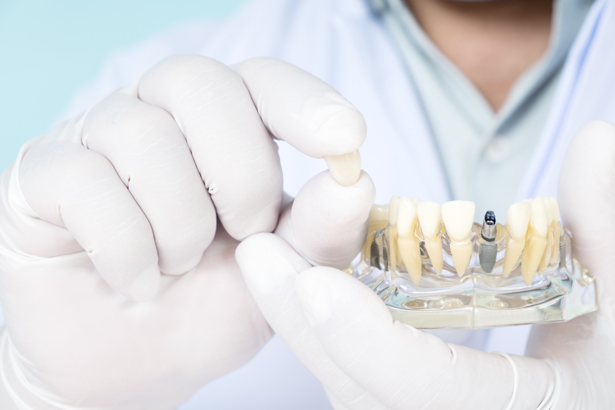 A Comprehensive Guide to ImplantSupported Dentures Seattle Specialty