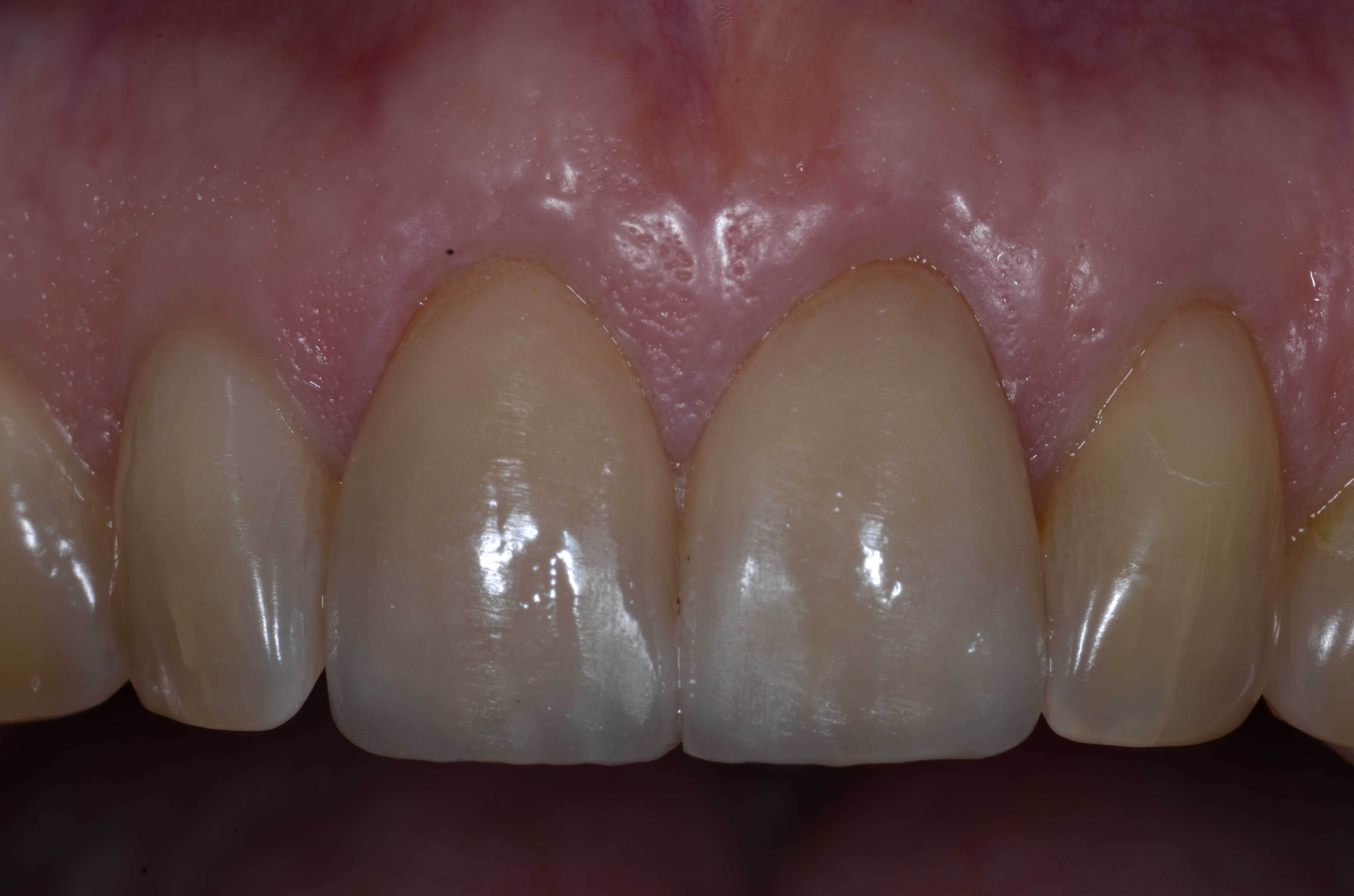 Porcelain Veneer Seattle Implant and Prosthetic Dentist